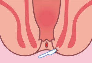 側方皮下内肛門括約筋切開術(LSIS)