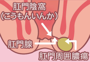 マイクリニック大久保肛門腺・肛門周囲膿瘍のイラスト